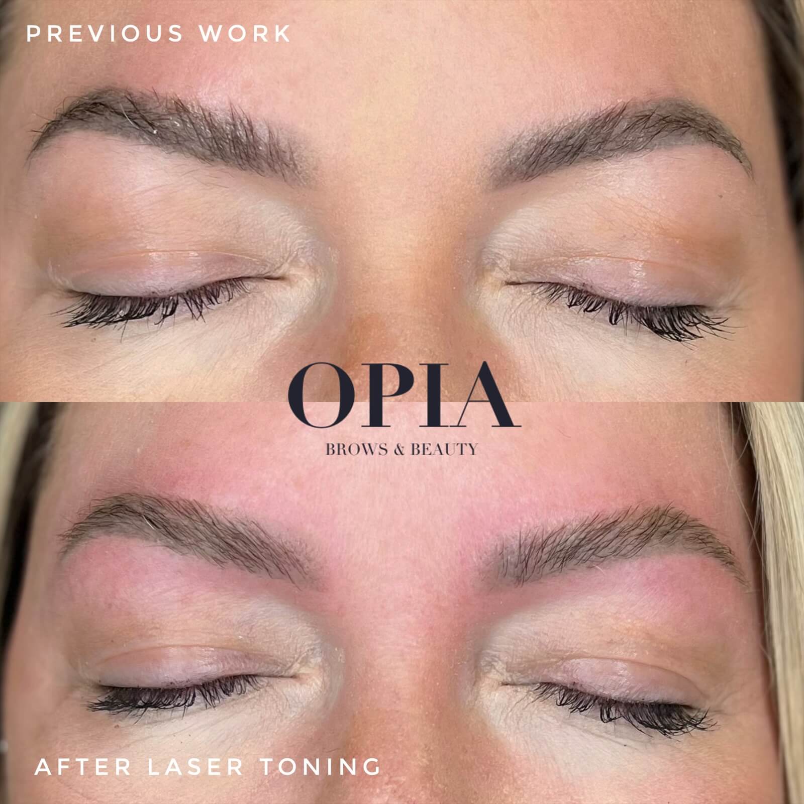 Before and After from one treatment of Laser Toning for Brows. Client had permanent makeup that turned dark grey, however the shape of the brow was still desirable. A low energy setting of laser removal is able to lightly shift the darkness to become lighter and warmer. She may want to do a corrective touchup in 4 weeks, or leave them be until they naturally fade through the year.