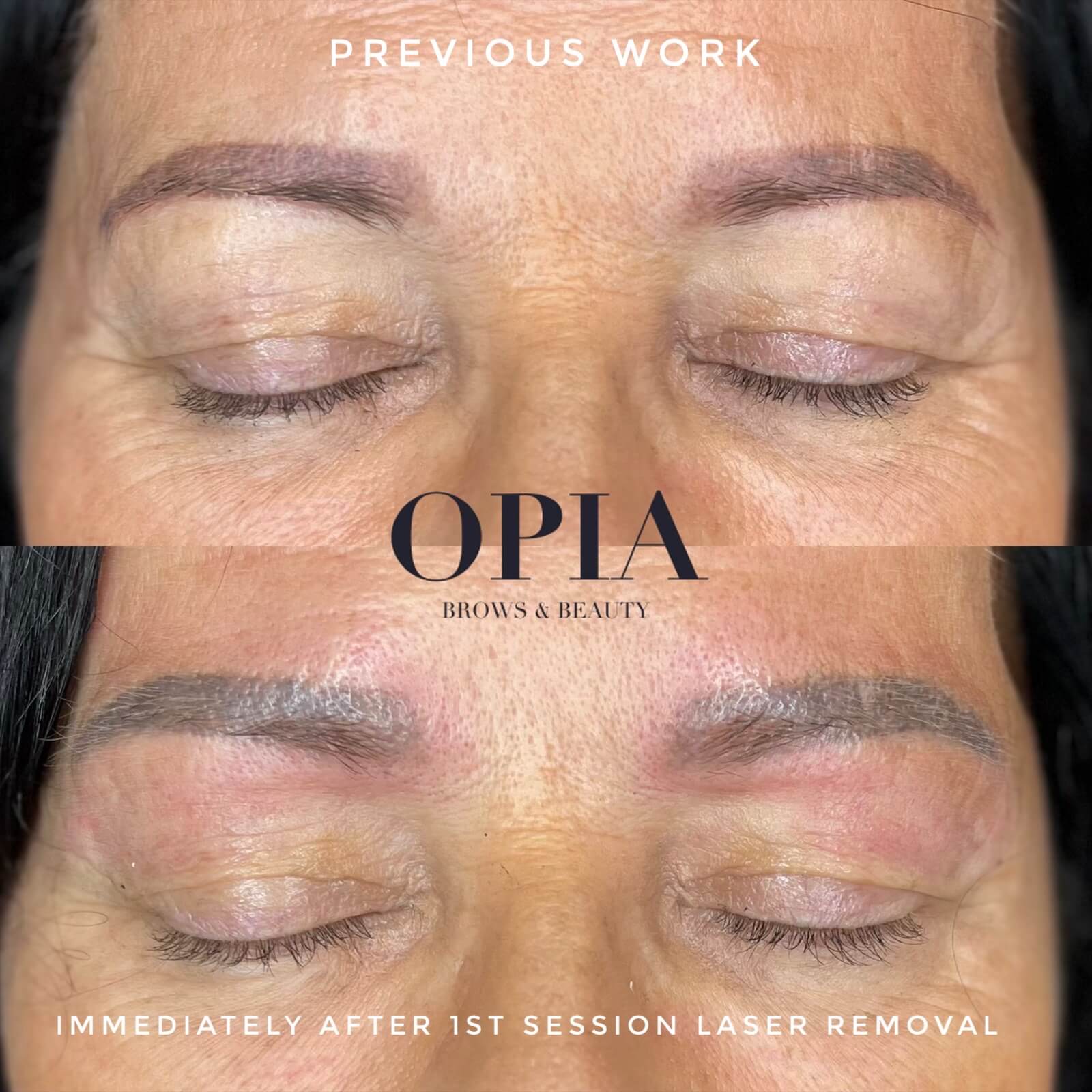 Before and after Laser Brow Removal Treatment for unwanted Permanent Makeup. Depicts patchy red/black brows before, and immediate after shows a grey outcome from the first session of removal.