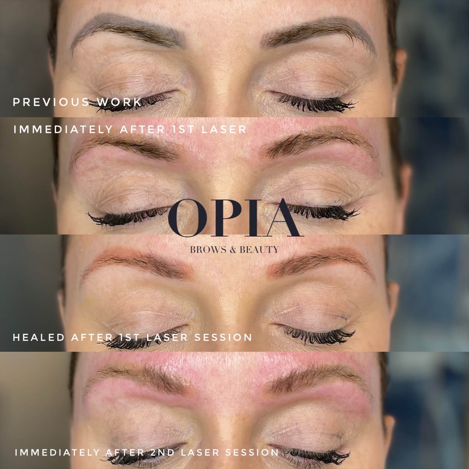 A series of 2 before and after Laser Brow Removal Treatments for unwanted Permanent Makeup. Depicts grey/black brows as the starting point, and the immediate after shows a light red outcome from the first session of removal. Followed by the 6 week healed result showing a bright red result, then the after 2nd treatment of laser showing a yellow outcome, which is the end point of laser removal. 