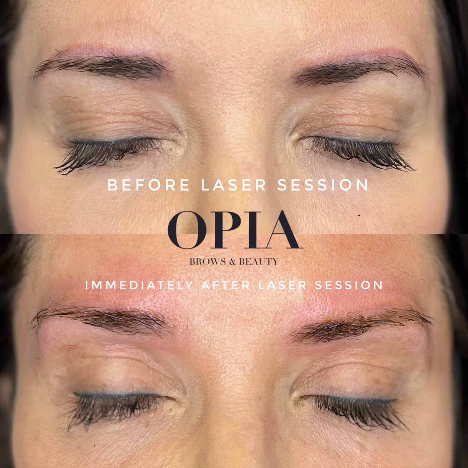 Before and After from one treatment of Laser Brow Removal. Starting point of purple/red/black brows, the client had been getting them done for 9 years. The immediate after shows them being very light however they will darken after an hour and require another session before seeing much change.