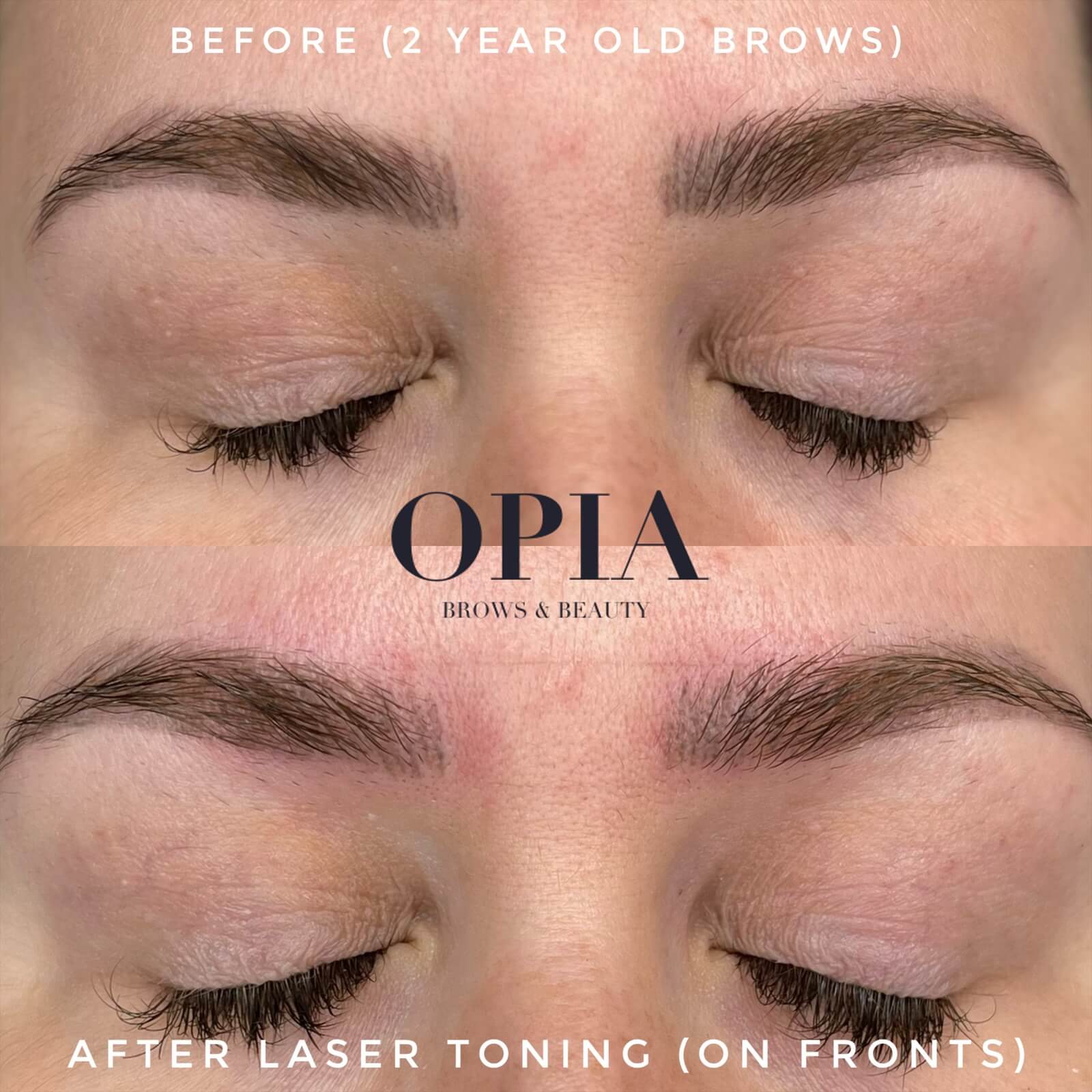 Before and After from one treatment of Laser Toning for Brows. Client had microblading that turned dark at the fronts, however the shading throughout the rest of the brow & shape was still desirable. A low energy setting of laser removal is able to lightly shift the darkness at the fronts to become lighter and warmer, and in 4 weeks be corrected with nano hairstrokes.