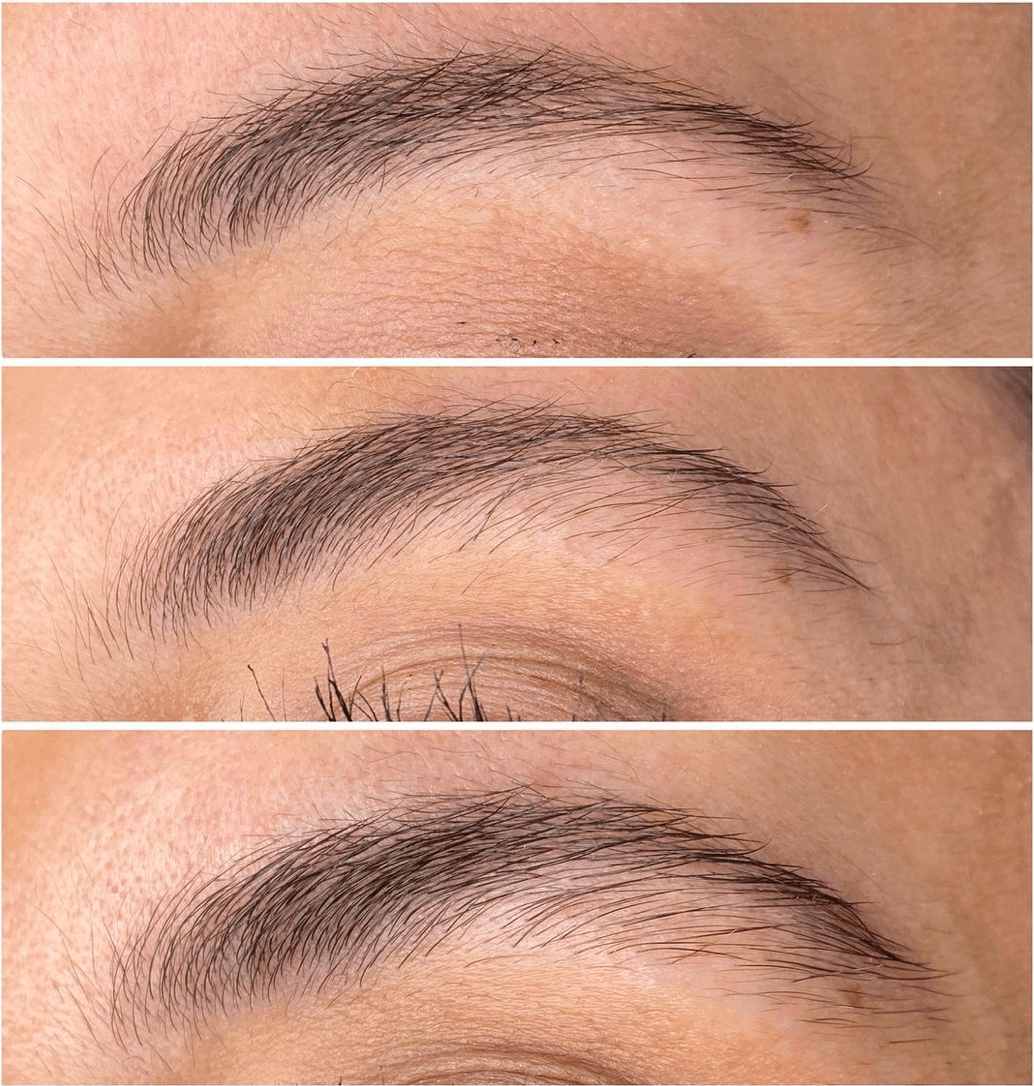 Photo depicting results after two sessions of eyebrow microneedling for regrowth and repair.